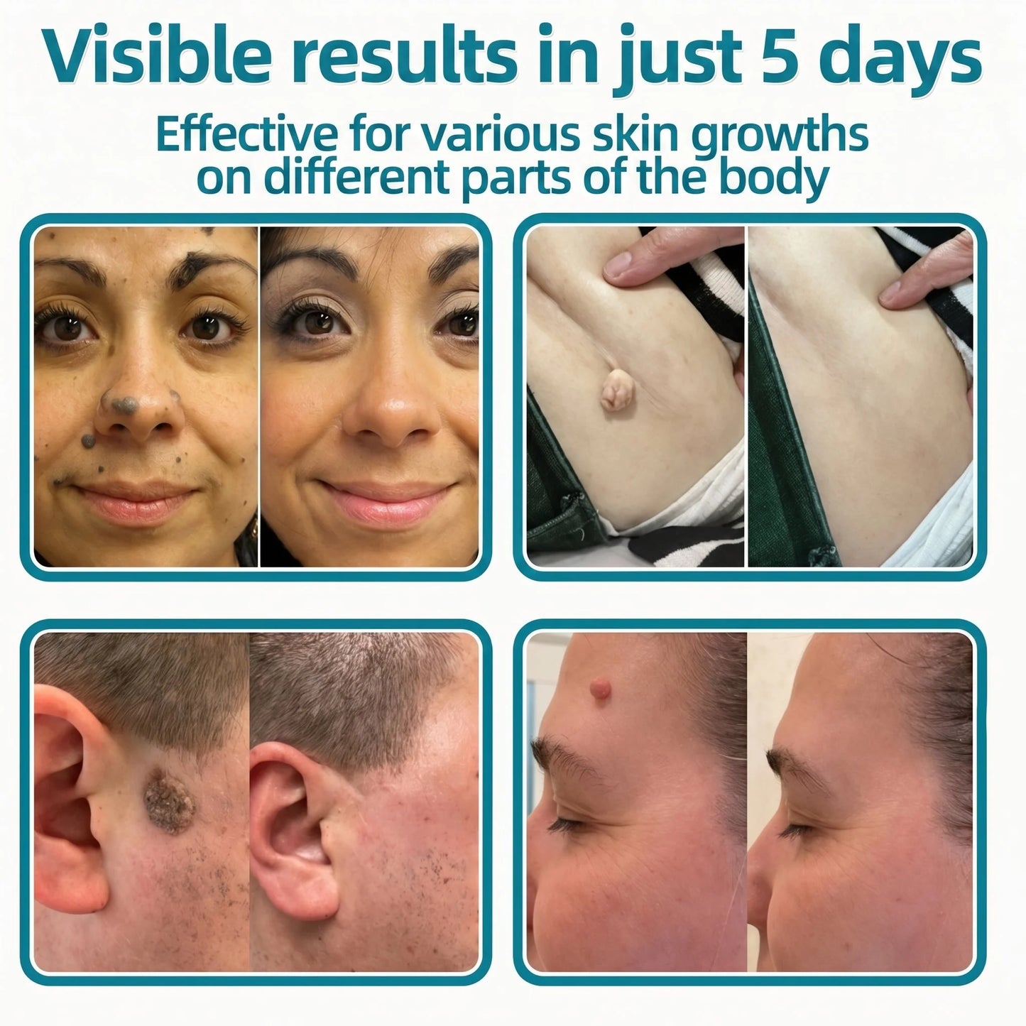 MicroNeedle Botanic Skin Tag Removal Patch