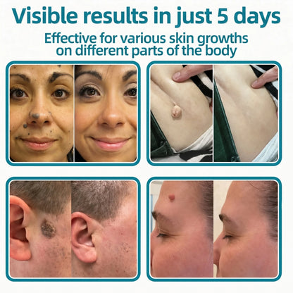 MicroNeedle Botanic Skin Tag Removal Patch