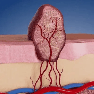MicroNeedle Botanic Skin Tag Removal Patch