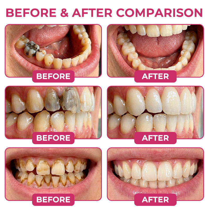 Cavity-Repair Natural Enamel Filling Gel